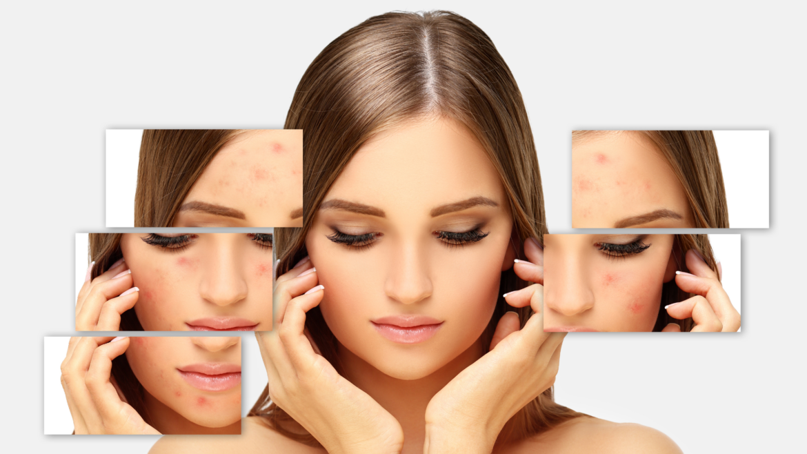 Keto, a leczenie trądziku?